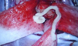 Bệnh nhân bị ký sinh trùng 7cm chui vào não